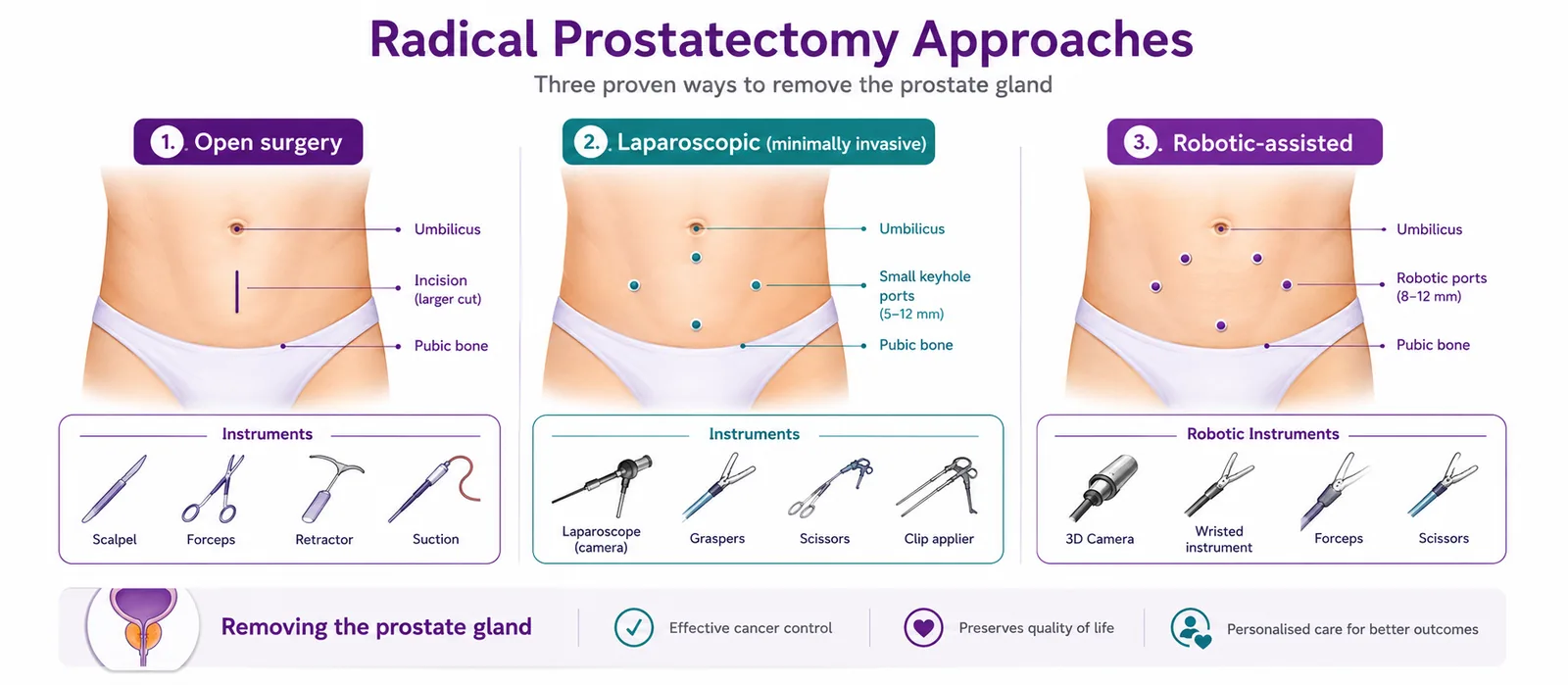 Radical prostatectomy approaches compared — open surgery, laparoscopic (minimally invasive) keyhole surgery and robotic-assisted surgery, with the instruments used for each