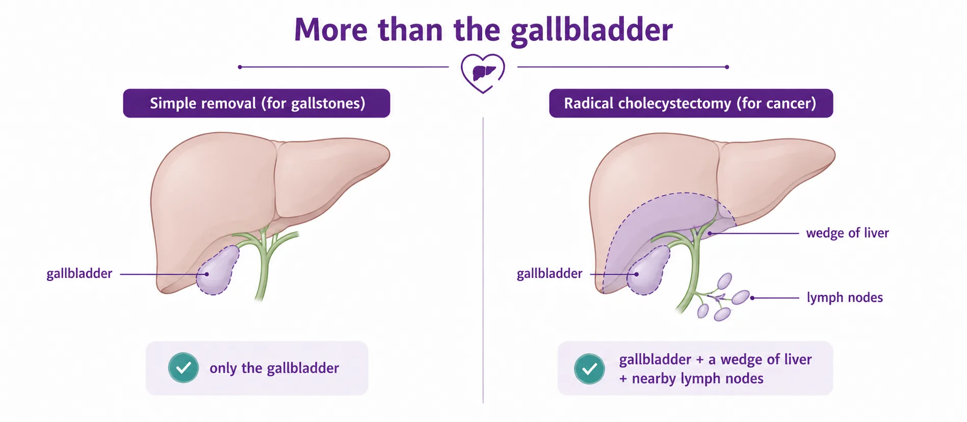Diagram comparing a simple gallbladder removal for gallstones, which takes only the gallbladder, with a radical cholecystectomy for cancer, which also removes a wedge of the liver bed and the nearby lymph nodes, CION Cancer Clinics Hyderabad