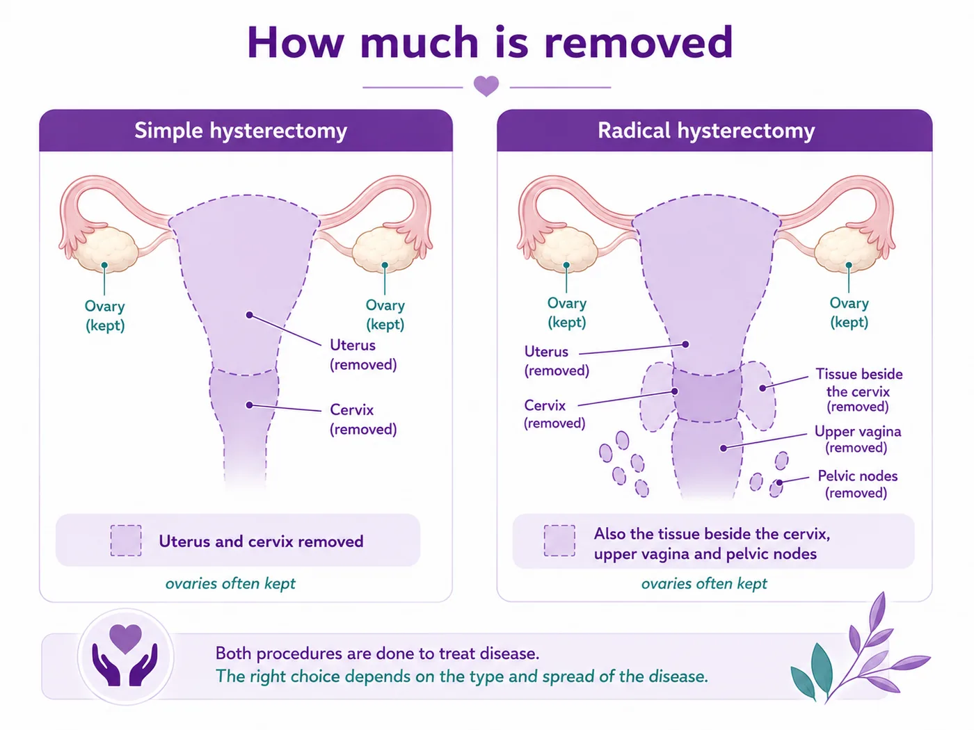 Diagram comparing a simple hysterectomy (uterus and cervix removed) and a radical hysterectomy (also the tissue beside the cervix, upper vagina and pelvic nodes removed, with ovaries often kept) for cervical cancer