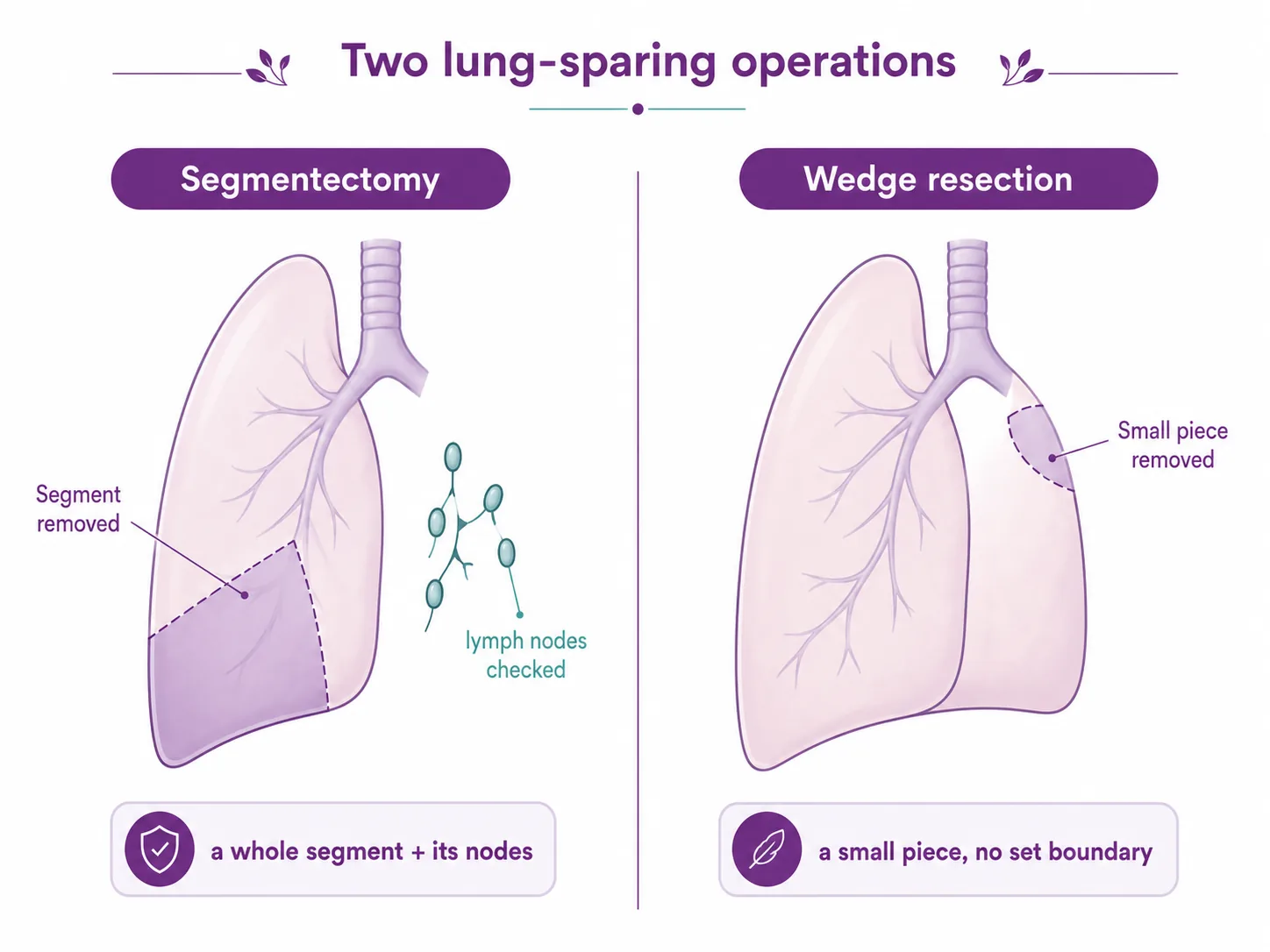 Diagram comparing a segmentectomy (removing a whole anatomical segment of the lung with its lymph nodes) with a wedge resection (removing a small non-anatomical piece), CION Cancer Clinics Hyderabad