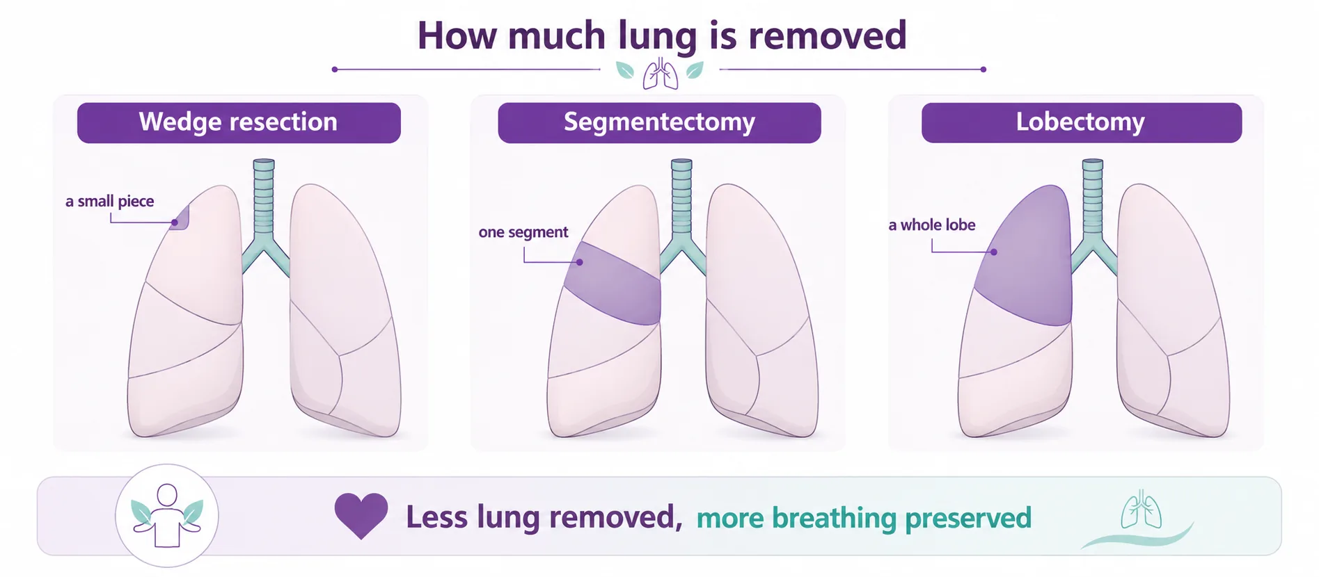 Diagram comparing how much lung is removed by a wedge resection, a segmentectomy and a lobectomy — a smaller sublobar operation removes less lung and preserves more breathing, CION Cancer Clinics Hyderabad