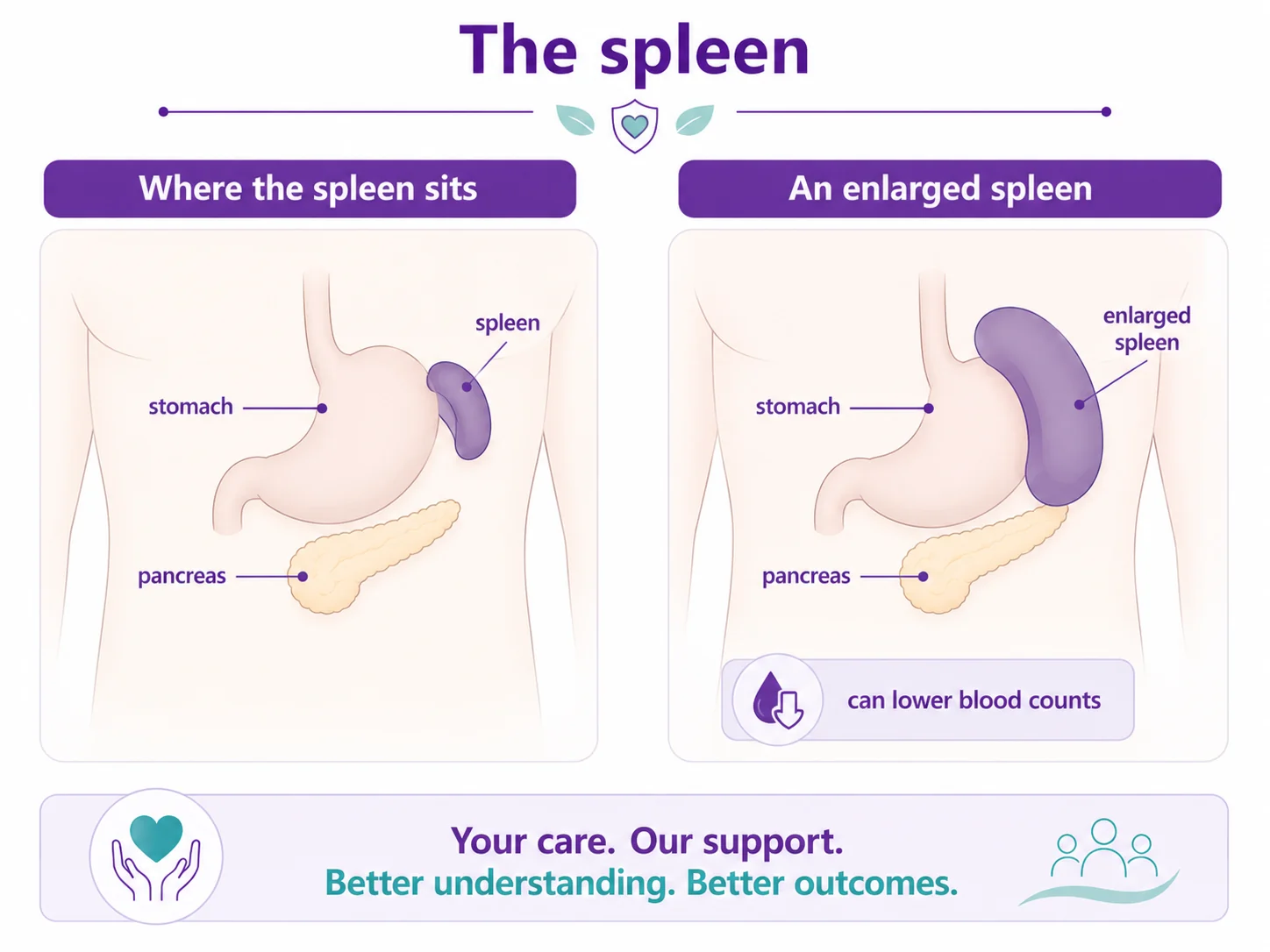 Diagram showing where the spleen sits in the upper-left abdomen beside the stomach and pancreas, and a normal spleen compared with an enlarged spleen that can lower blood counts, CION Cancer Clinics Hyderabad