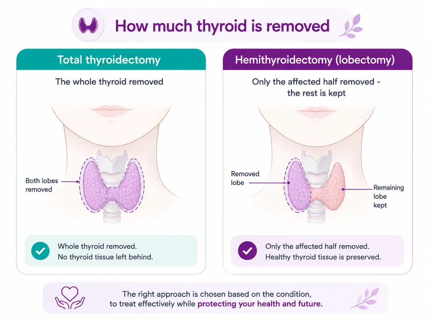 Diagram comparing total thyroidectomy, where the whole thyroid is removed, and hemithyroidectomy or lobectomy, where only the affected half is removed and the healthy lobe is kept