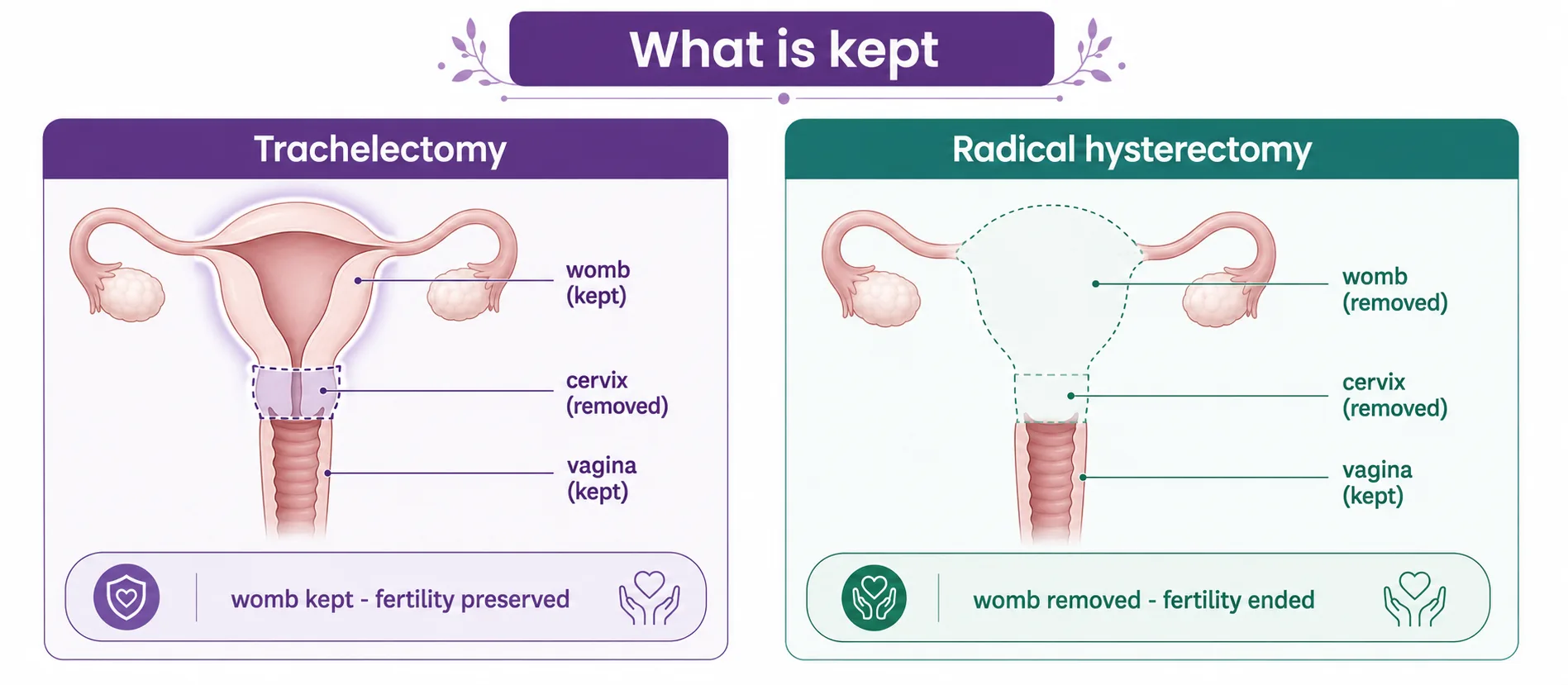 Diagram comparing a trachelectomy, which removes the cervix but keeps the womb so fertility is preserved, with a radical hysterectomy, which removes the womb and ends fertility