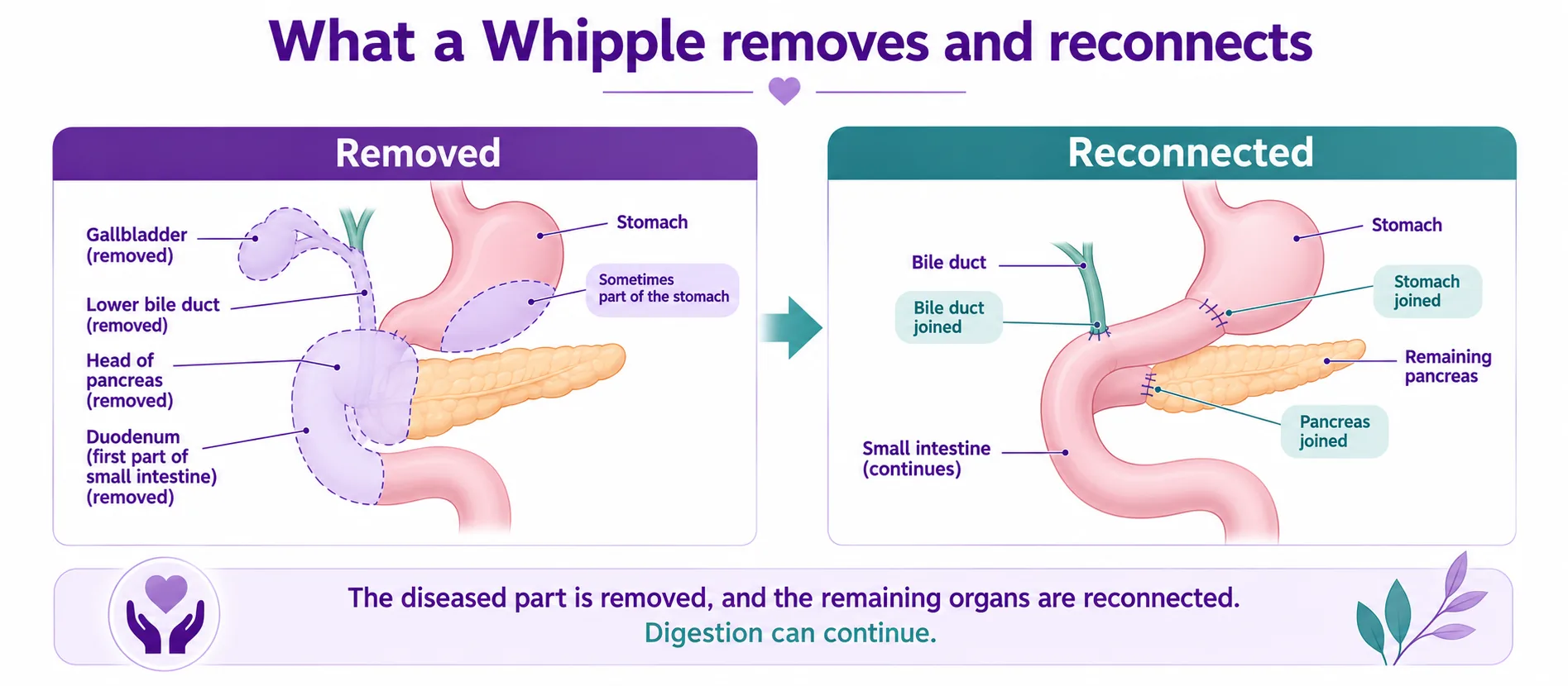 Two-panel diagram showing what a Whipple procedure removes (head of the pancreas, duodenum, gallbladder, lower bile duct and sometimes part of the stomach) and how the remaining pancreas, bile duct and stomach are reconnected to the small intestine so digestion can continue