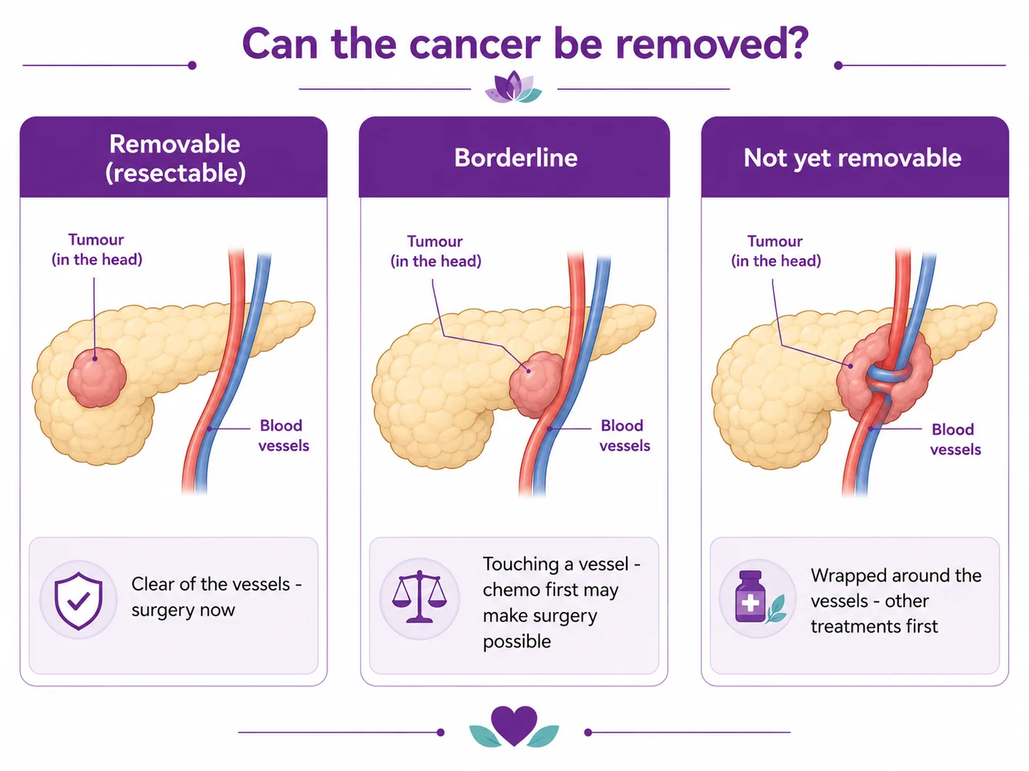 Three-panel diagram comparing removable (resectable), borderline and not-yet-removable pancreatic cancer, based on whether the tumour in the head of the pancreas is clear of the nearby blood vessels
