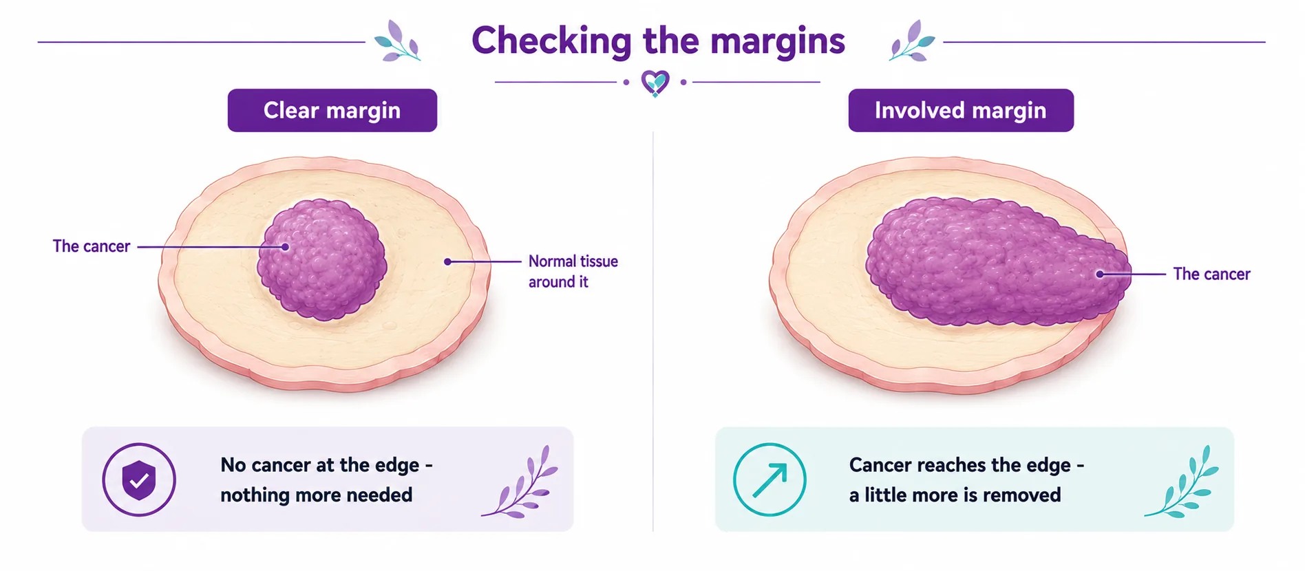 Diagram comparing a clear margin (no cancer at the edge, nothing more needed) and an involved margin (cancer reaches the edge, so a little more is removed) after a wide local excision, CION Cancer Clinics Hyderabad