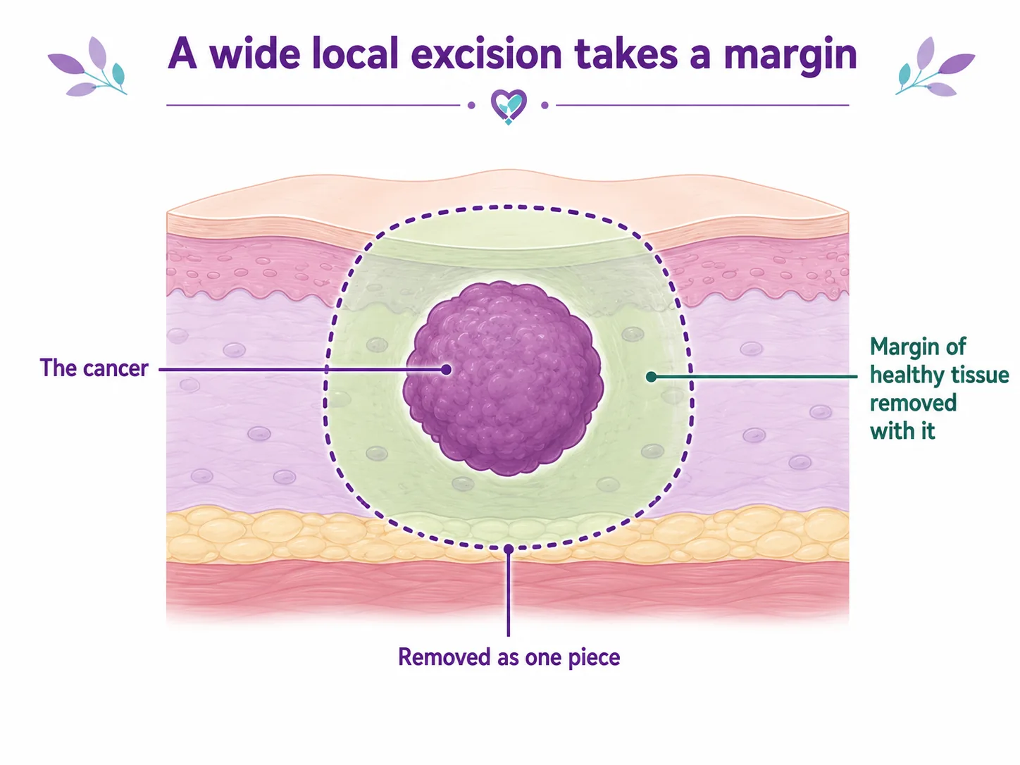 Diagram of the surgical margin in a wide local excision — the cancer removed together with a rim of healthy tissue all around and beneath it, taken out as one piece, CION Cancer Clinics Hyderabad