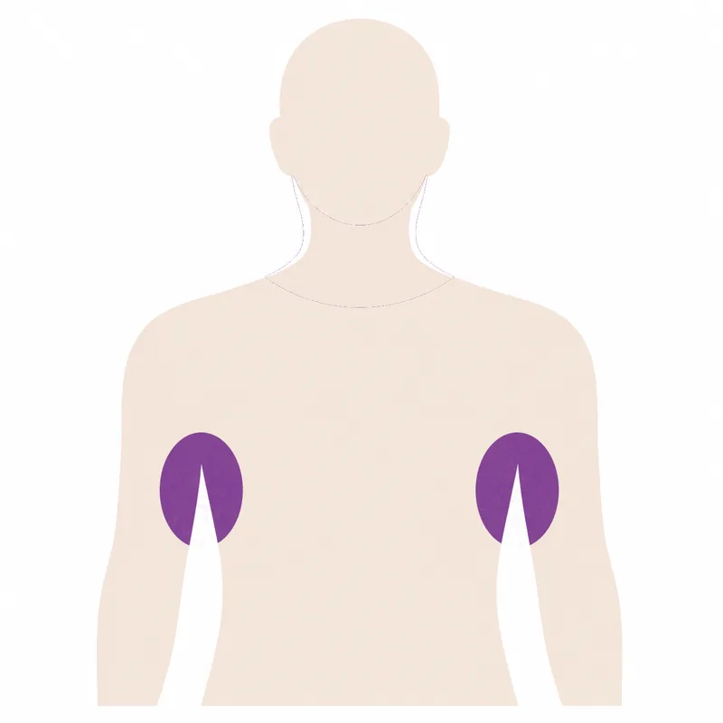 Body diagram with the armpit nodes marked, a soft-tissue site biopsied under ultrasound guidance