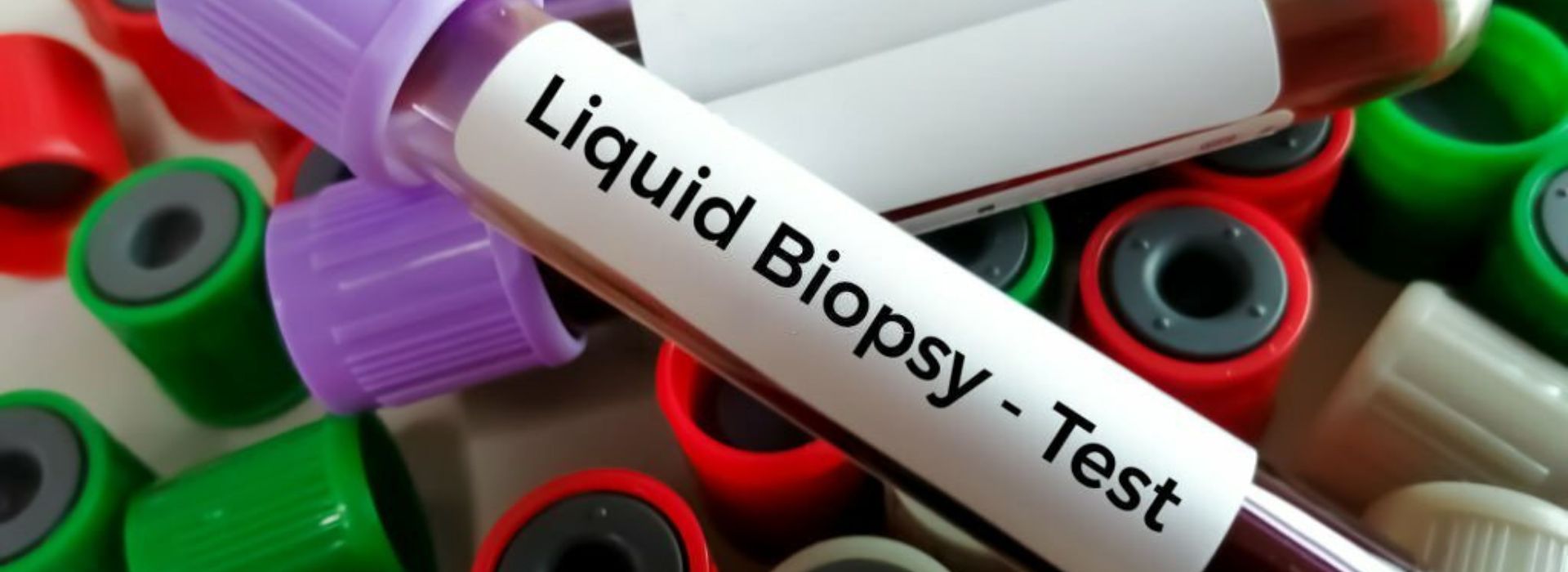 Liquid biopsy An Advanced technique To Detect Cancer 