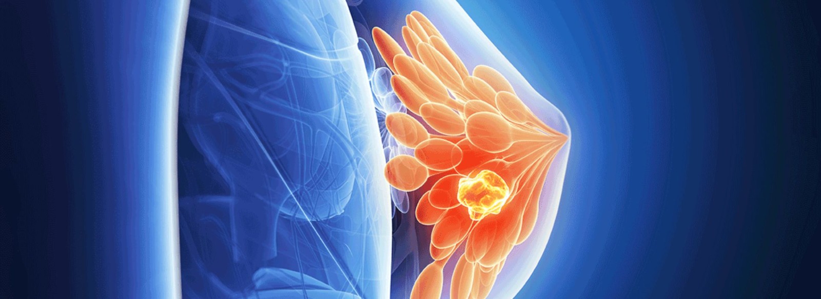 What is Ductal Carcinoma In Situ DCIS