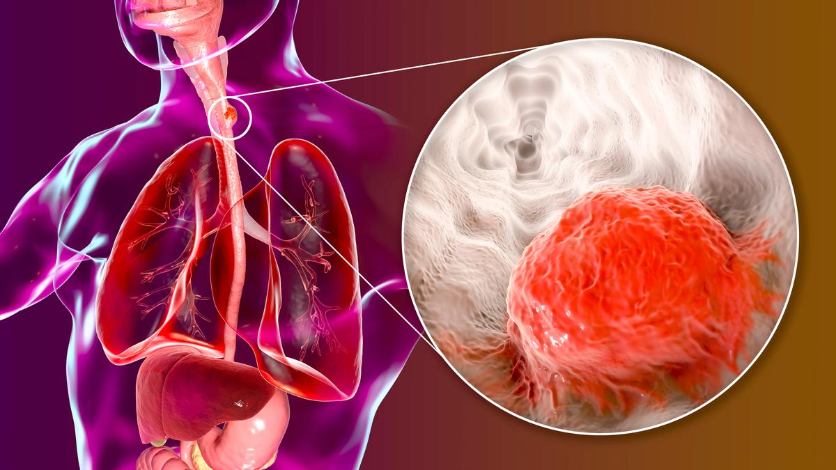 Understanding Diagnostic Procedures For Esophageal Cancer