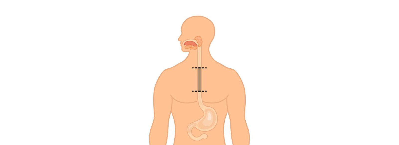 Treatment  Options For Esophageal Cancer