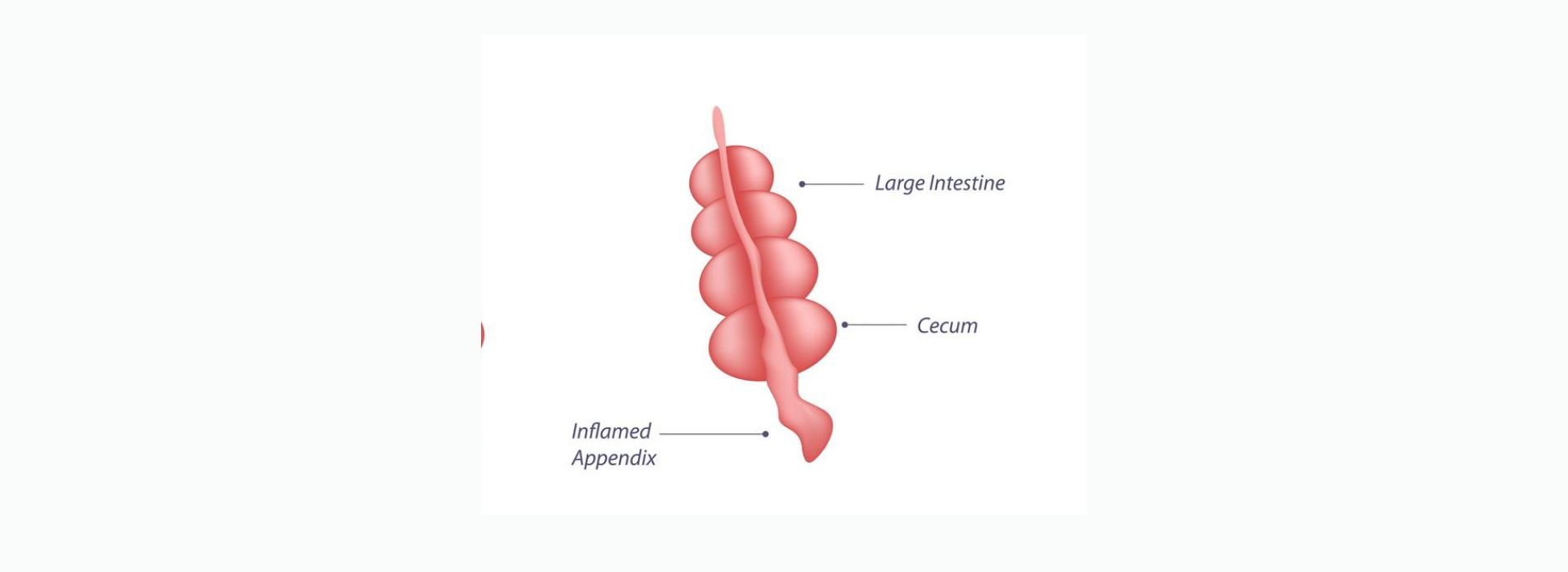  How Is Stage 1 Appendix Cancer Treated