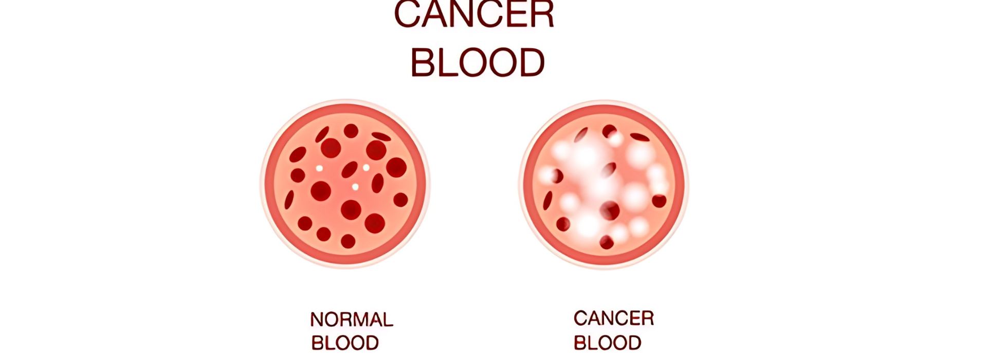 Leukemia symptoms 