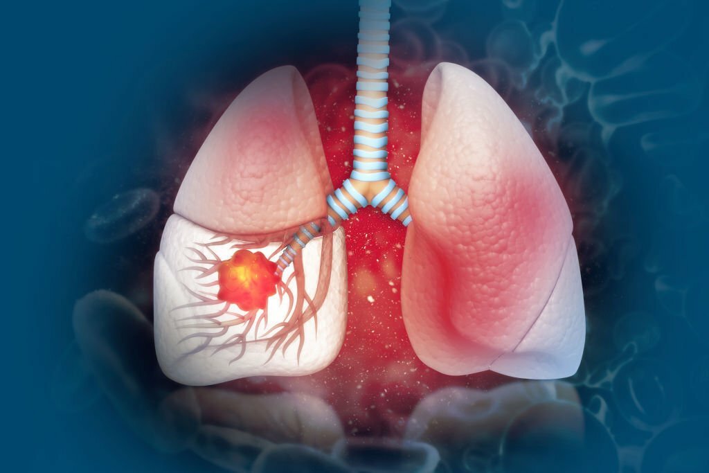 What are the types of lung cancer 