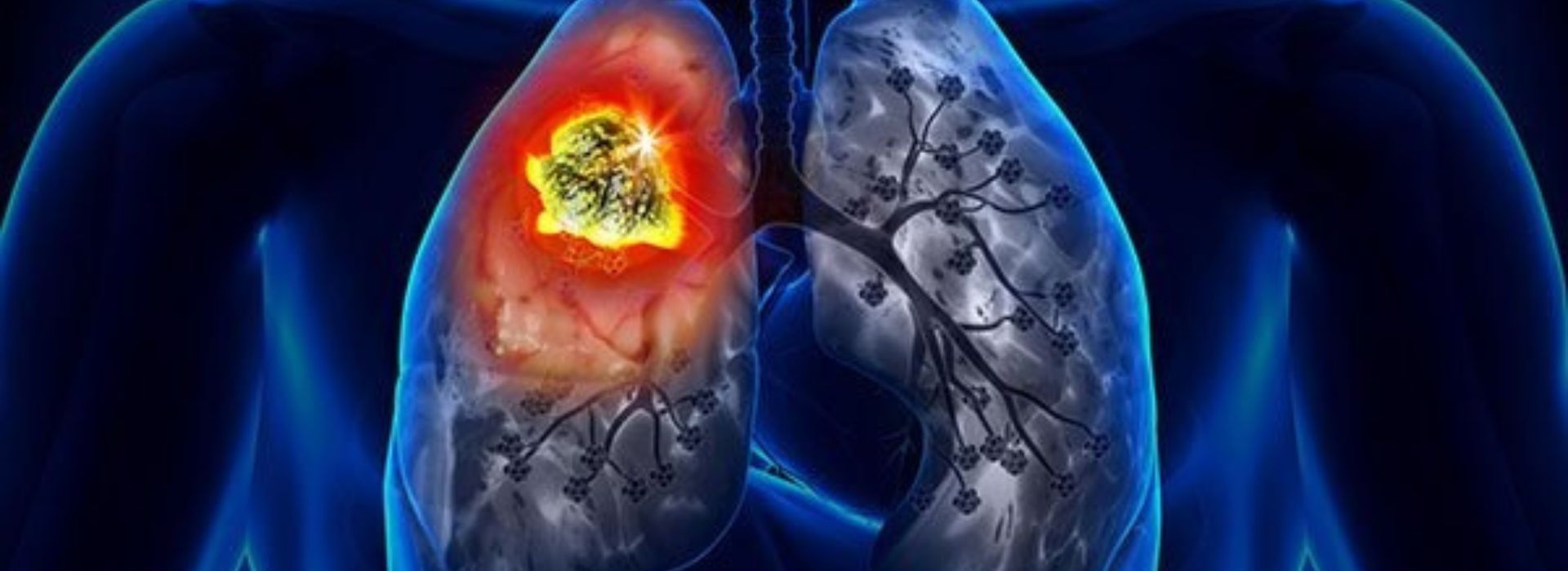 Evolution Of Lung Cancer Diagnosis: From Traditional Techniques To Future Innovations