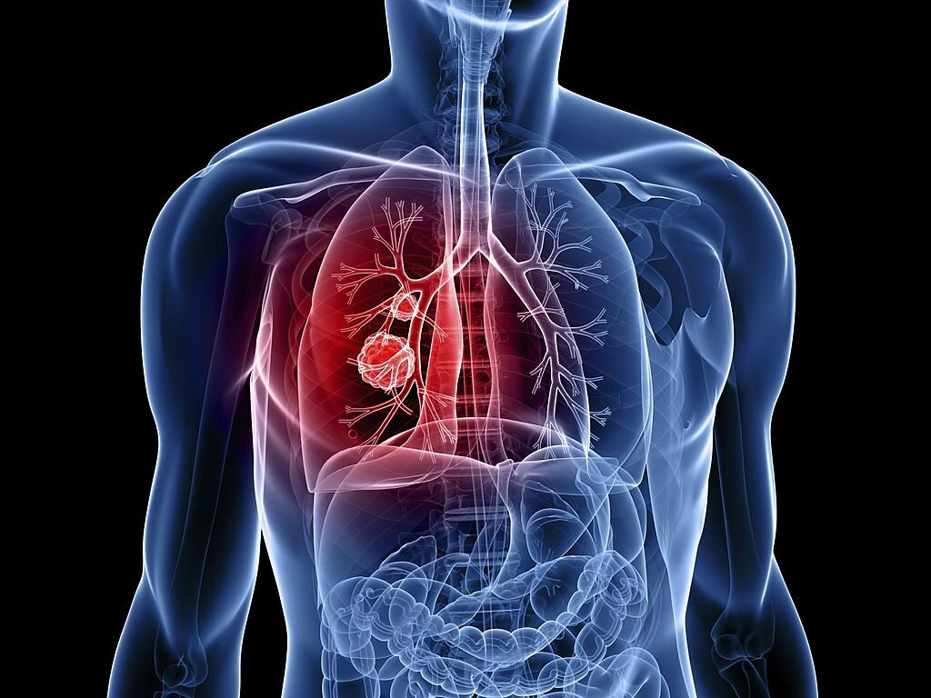 Computed Tomography (CT): A Diagnostic Tool To Look For Lung Cancer 