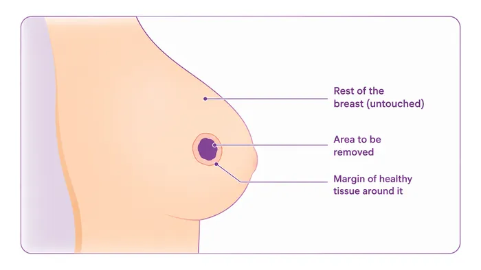 Lumpectomy - what is removed - CION Cancer Clinics