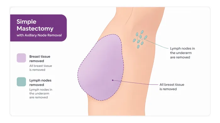 Mastectomy with node clearance - what is removed - CION Cancer Clinics