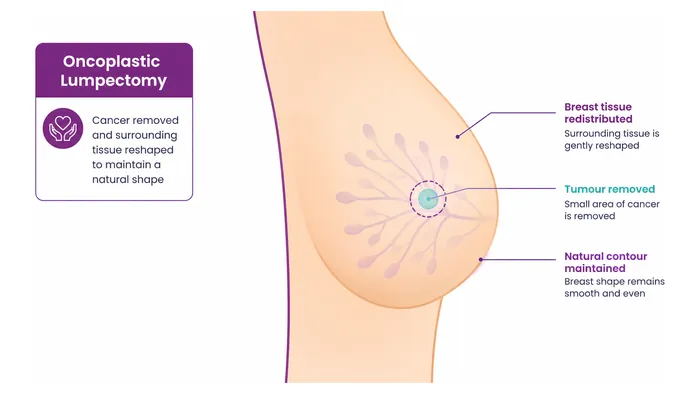Lumpectomy with reshaping - what is removed - CION Cancer Clinics
