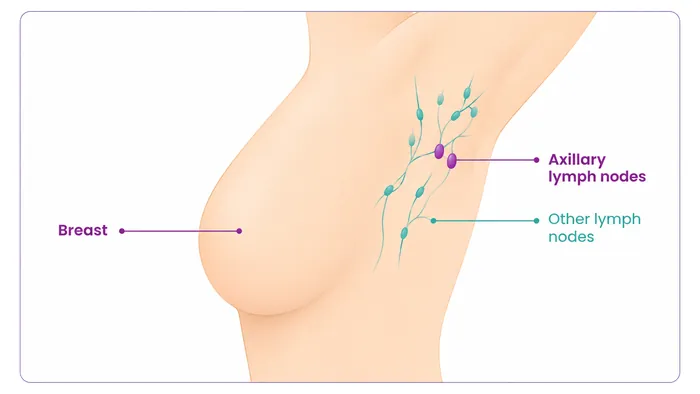 Sentinel node biopsy - what is removed - CION Cancer Clinics