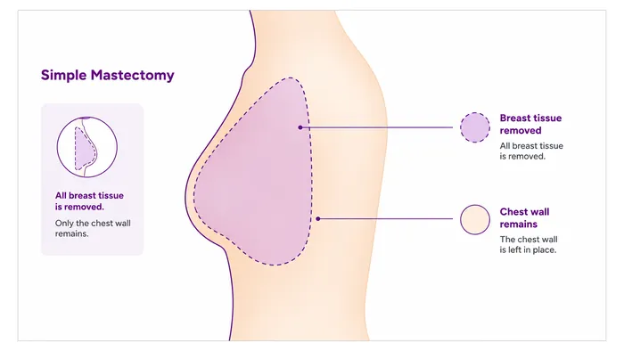 Simple mastectomy - what is removed - CION Cancer Clinics