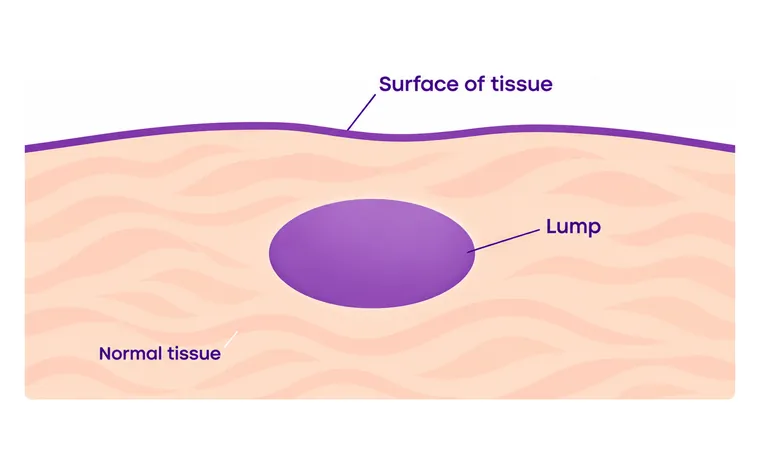 Fibroadenoma - one of the common causes of a breast lump - CION Cancer Clinics