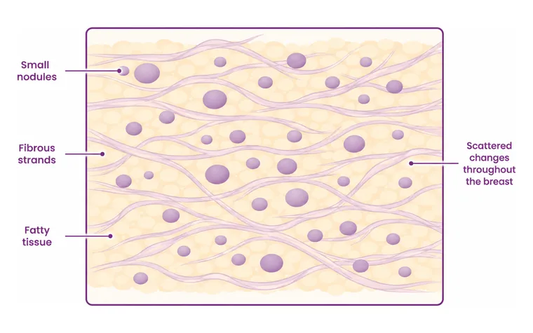 Fibrocystic change - one of the common causes of a breast lump - CION Cancer Clinics