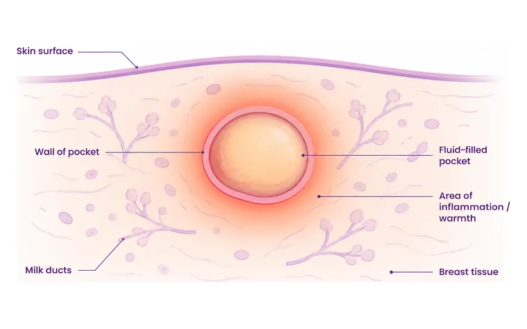 Infection or abscess - one of the common causes of a breast lump - CION Cancer Clinics