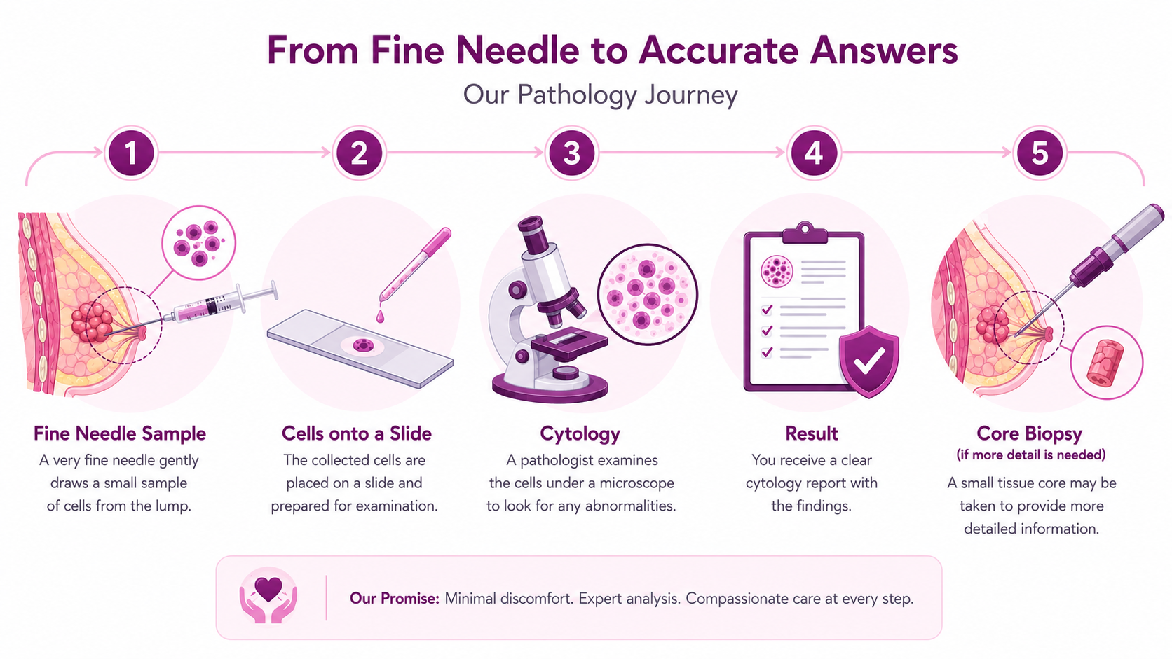 The FNAC pathology journey in five steps: 1. a fine needle draws a small sample of cells from the breast lump, 2. the cells are placed onto a slide, 3. a pathologist examines them under a microscope (cytology), 4. you receive a clear cytology report, and 5. a core biopsy is taken only if more detail is needed