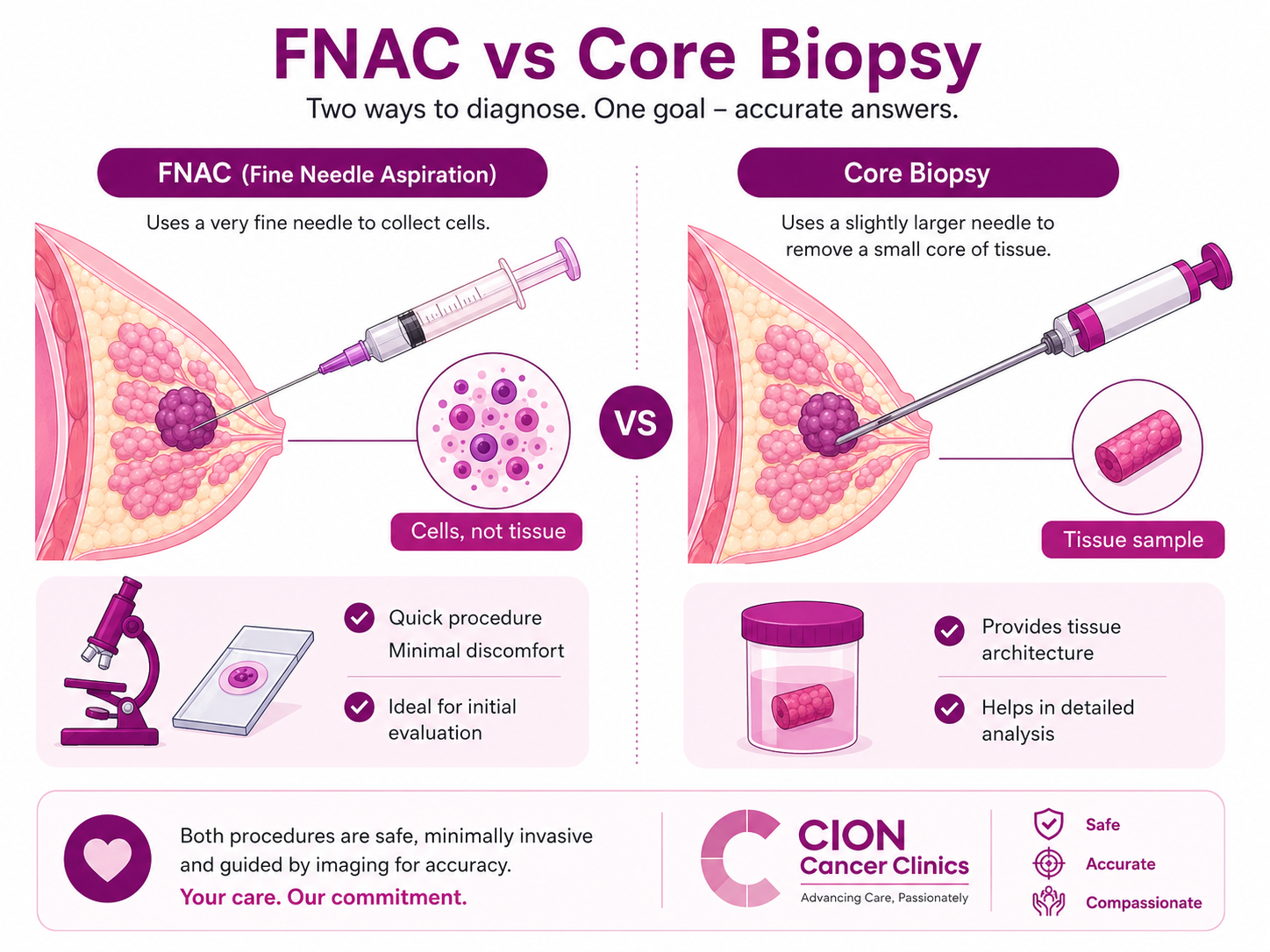 FNAC vs core needle biopsy of the breast compared side by side: FNAC uses a very fine needle to collect loose cells (cells, not tissue), while a core biopsy uses a slightly larger needle to remove a small core of tissue for detailed analysis