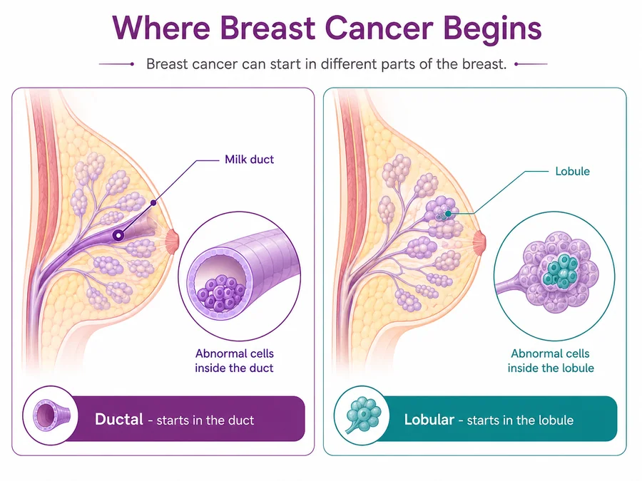 Diagram comparing ductal and lobular breast cancer starting points - CION Cancer Clinics