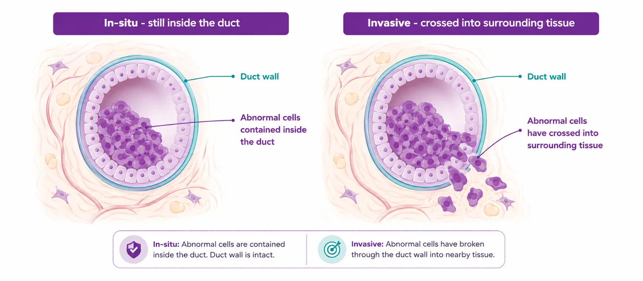 Diagram comparing in-situ and invasive breast cancer inside a milk duct - CION Cancer Clinics