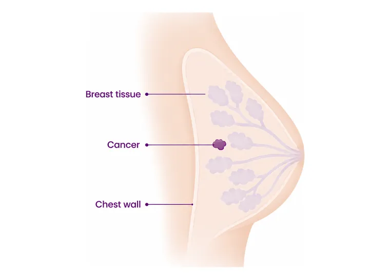 Stage 0 and 1 breast cancer - where the cancer is - CION Cancer Clinics