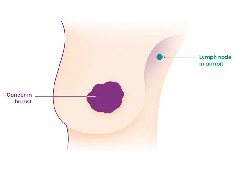 Stage 2 breast cancer - where the cancer is - CION Cancer Clinics