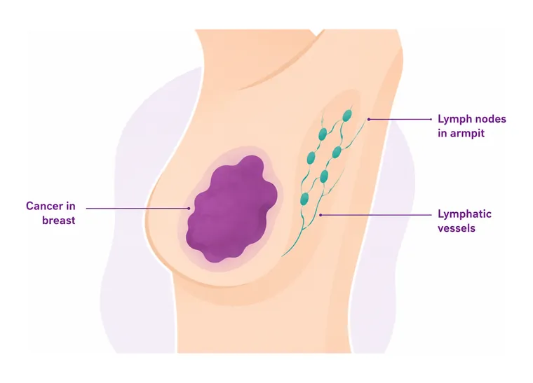 Stage 3 breast cancer - where the cancer is - CION Cancer Clinics