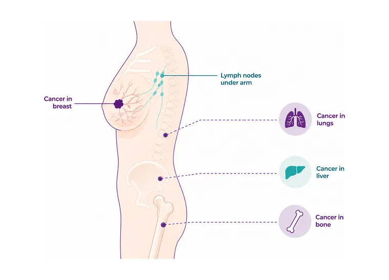 Stage 4 breast cancer - where the cancer is - CION Cancer Clinics