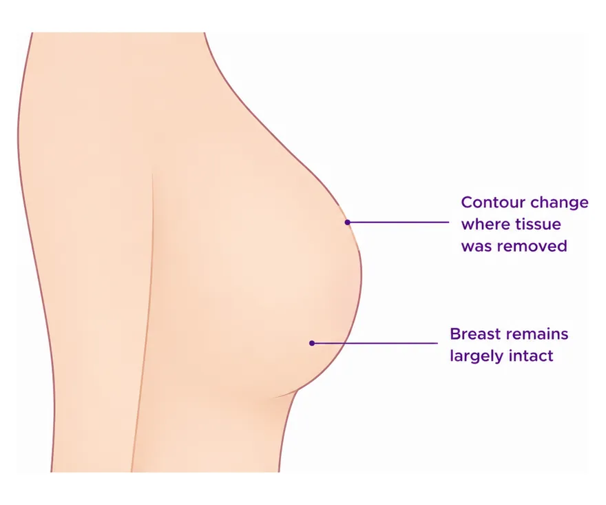 After a lumpectomy - CION Cancer Clinics