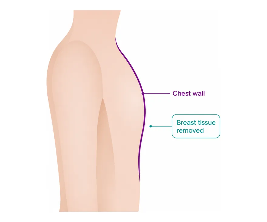 After a mastectomy - CION Cancer Clinics