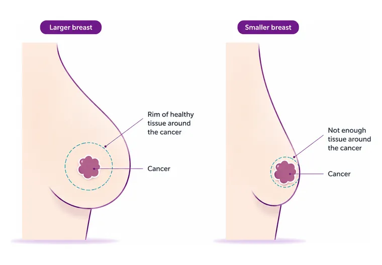 Too large for the breast - CION Cancer Clinics