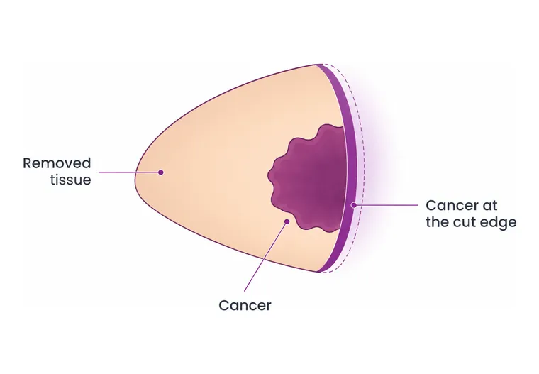 The margin stays involved - CION Cancer Clinics