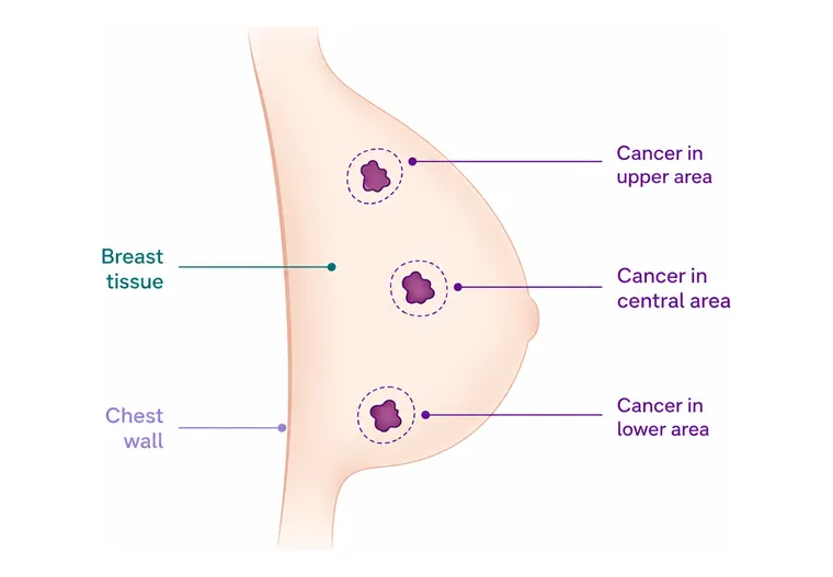 More than one area - CION Cancer Clinics