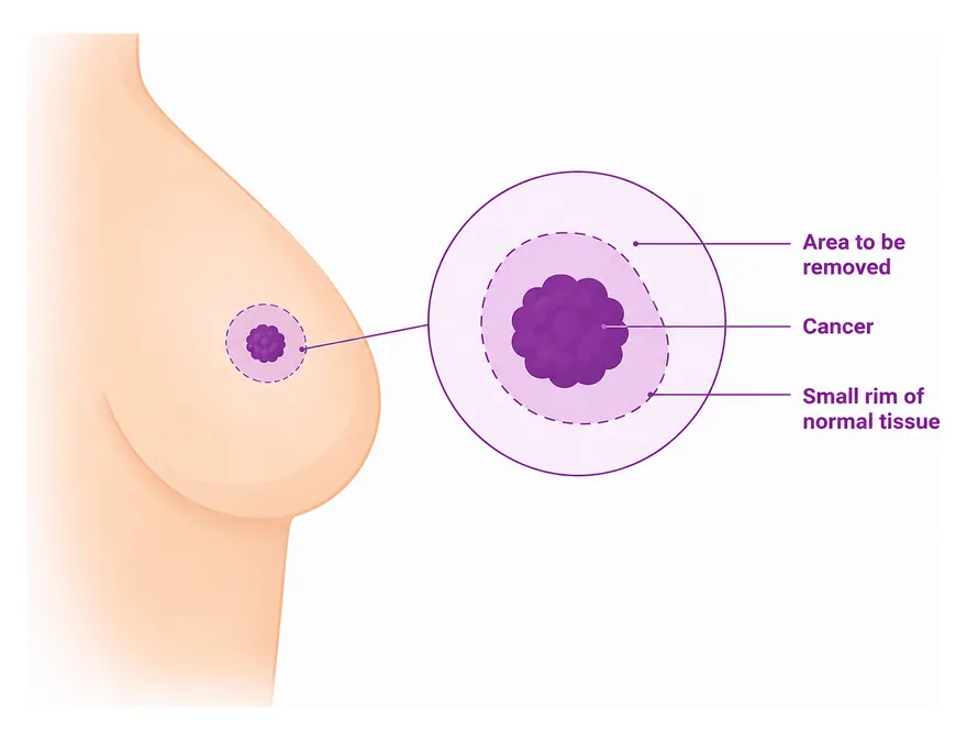 What a lumpectomy removes - the cancer with a rim of tissue around it - CION Cancer Clinics
