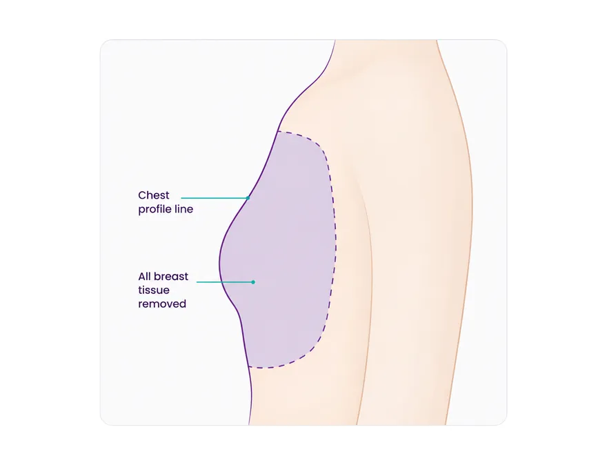 What a mastectomy removes - all the breast tissue on that side - CION Cancer Clinics