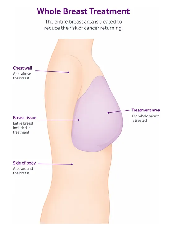 After a lumpectomy the whole breast is usually treated - CION Cancer Clinics