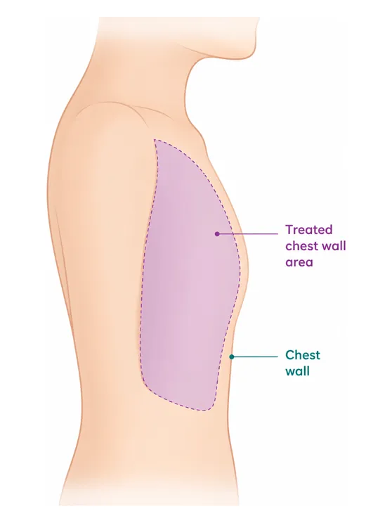 After a mastectomy the chest wall is treated, and only for a specific reason - CION Cancer Clinics