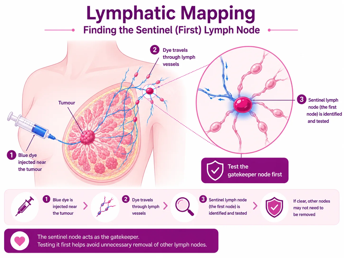 Lymphatic mapping diagram: blue dye injected near the breast tumour travels through the lymph vessels to identify the sentinel (first) lymph node — the gatekeeper node tested first to avoid unnecessary node removal