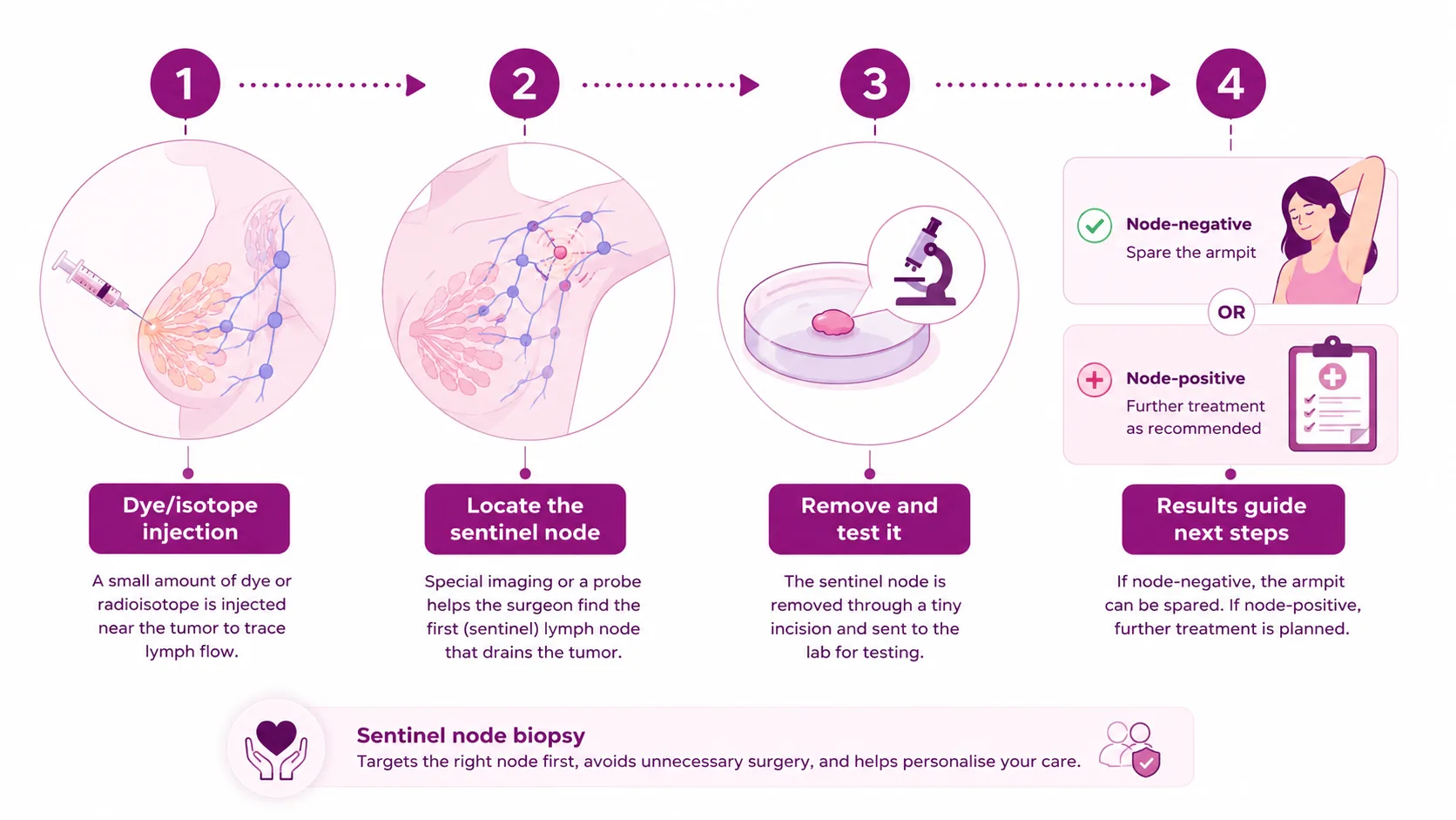 Four steps of a sentinel node biopsy: 1) dye or isotope injection to trace lymph flow, 2) locate the sentinel node, 3) remove and test it, 4) results guide next steps — node-negative spares the armpit, node-positive means further treatment