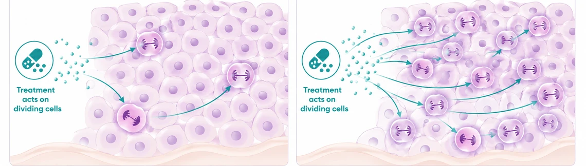 Why a higher tumour grade can mean treatment has more to act on - CION Cancer Clinics